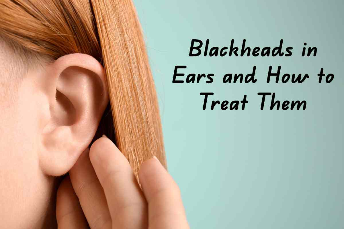 Blackheads in Ears and How to Treat Them